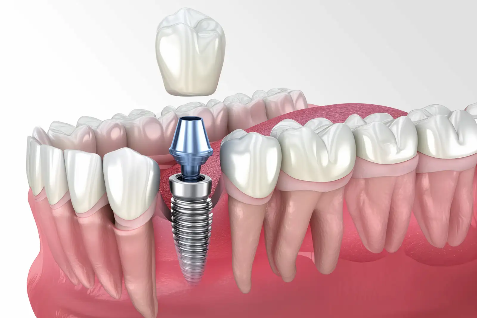 Corona su impianto dentale