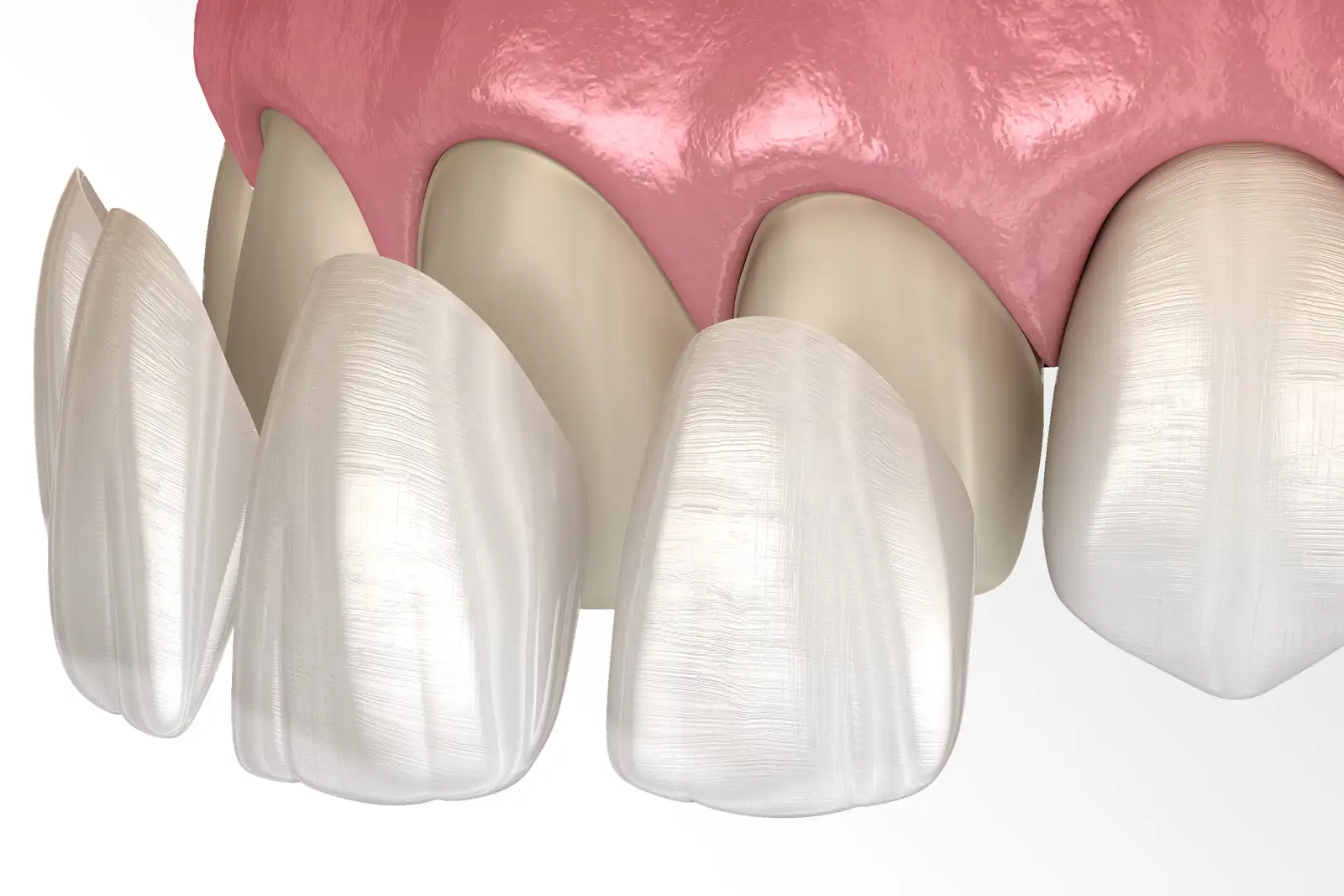 Faccette dentali