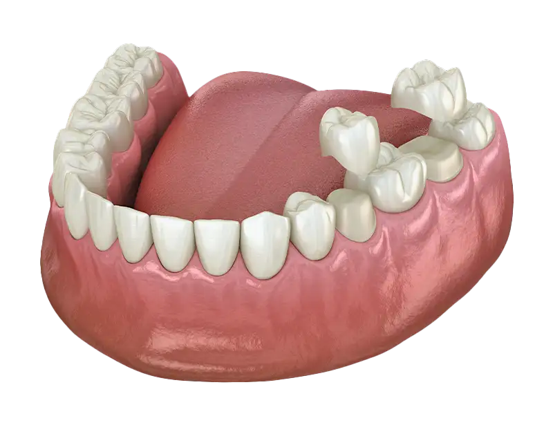 Restauro e cura dei denti