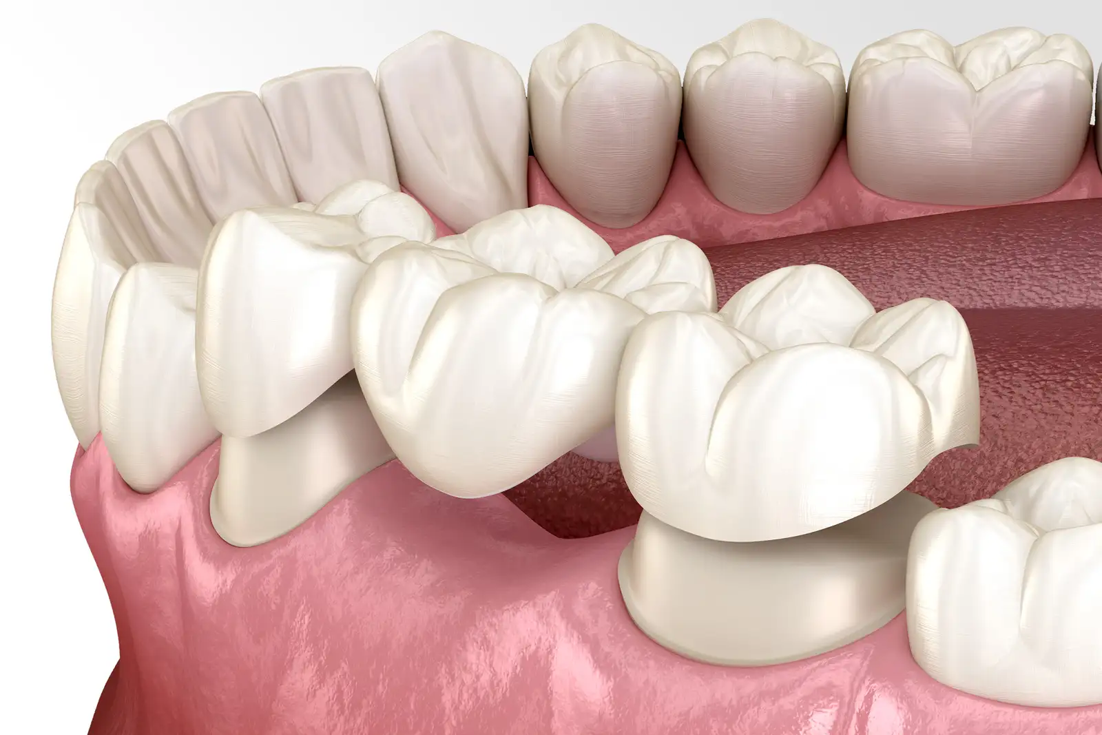 Ponte su impianti dentali