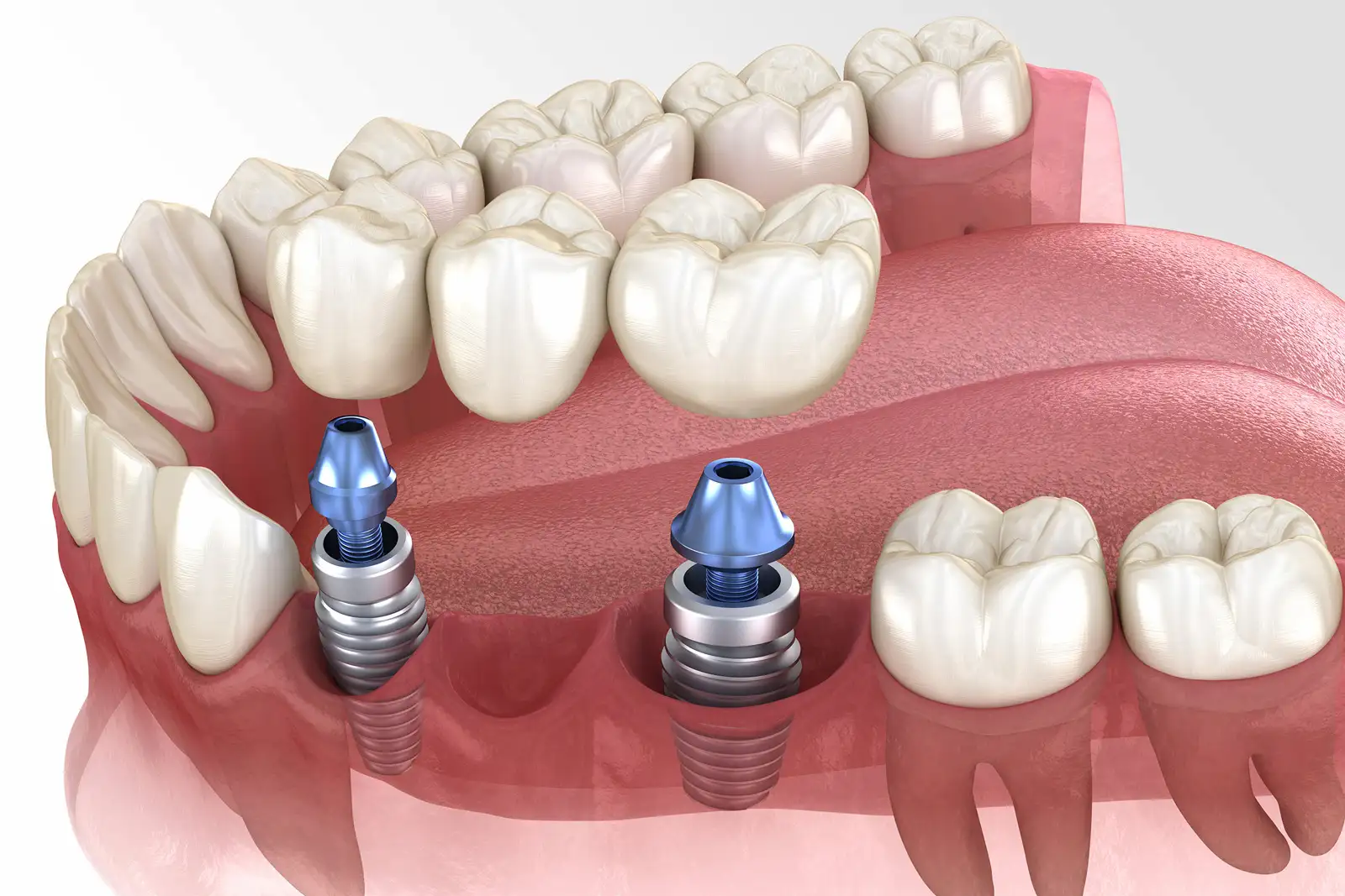 Ponte su impianti dentali