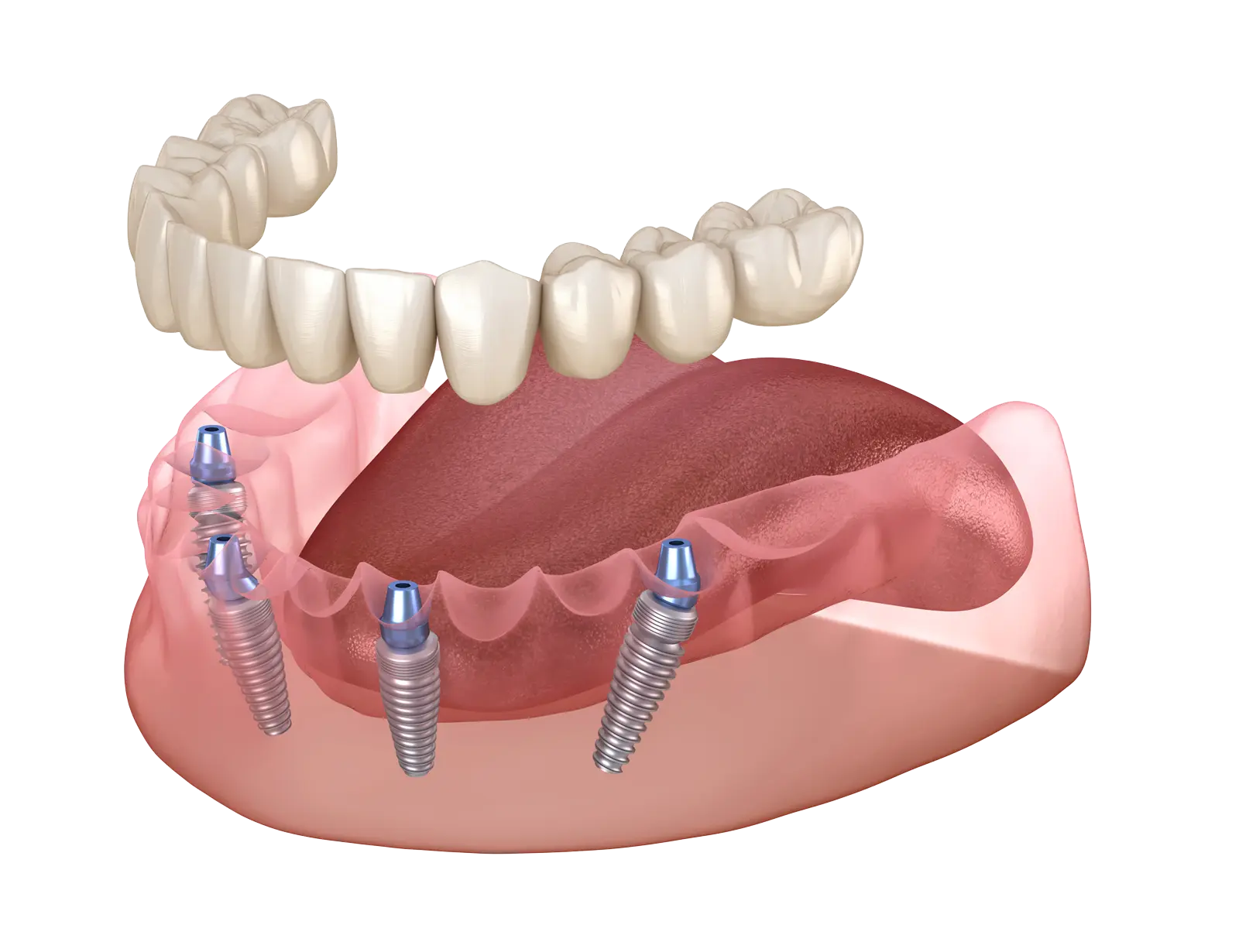 Implantologia dentale e protesi su impianti
