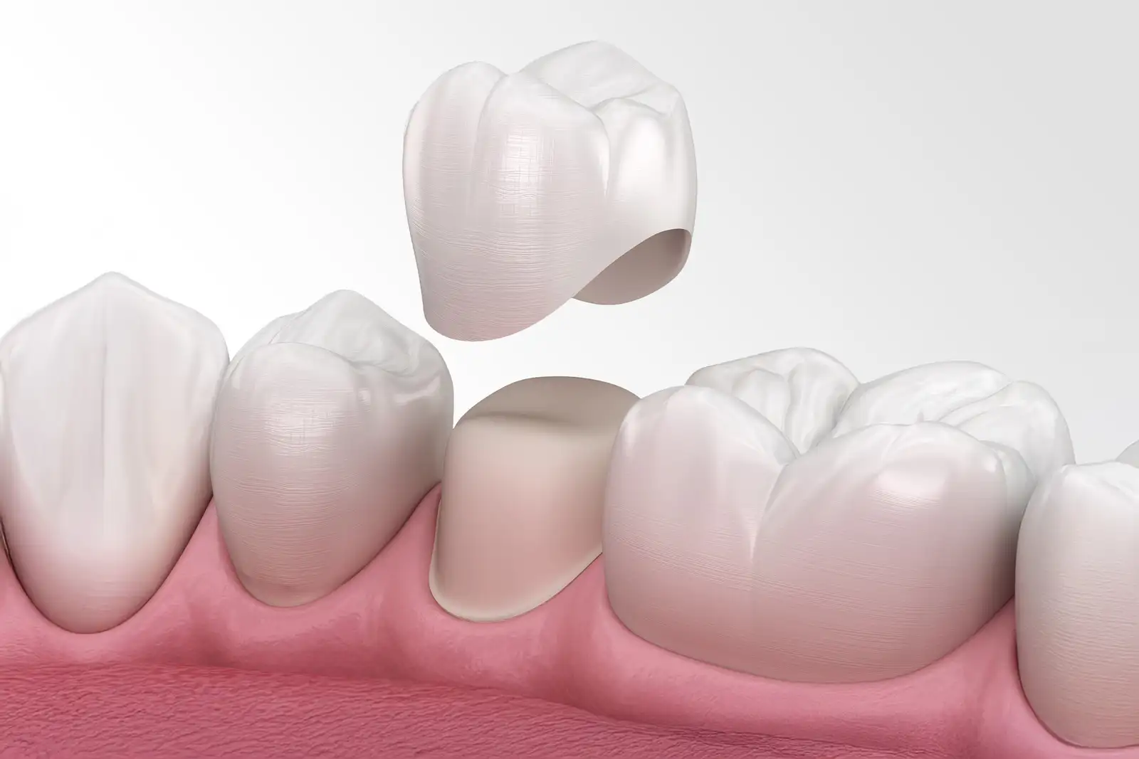 Corona su impianto dentale